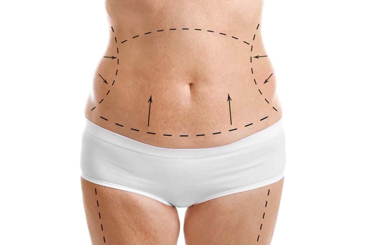 Tummy Tuck in Istanbul — Estetica Istanbul