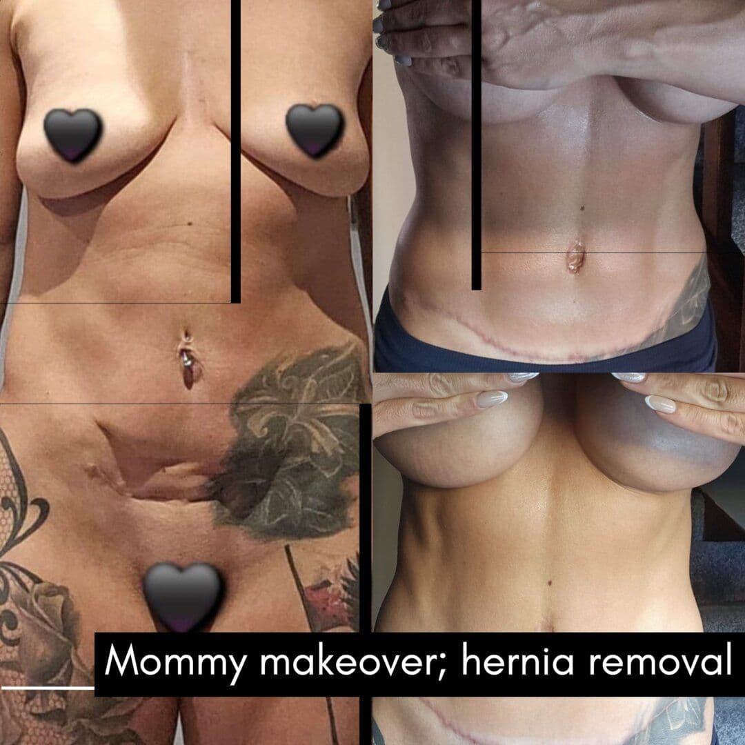 Mommy Makeover Cost 2026: Turkey vs UK, US, Germany and Italy