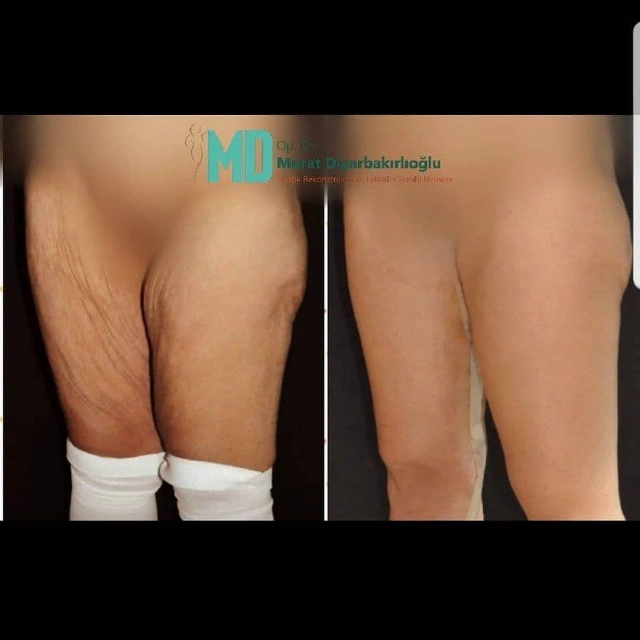 Thigh Lift Before After Photo 01 2