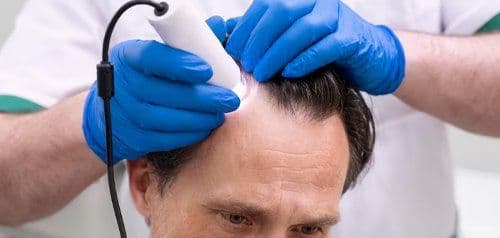 È possibile risolvere un trapianto di capelli fallito?