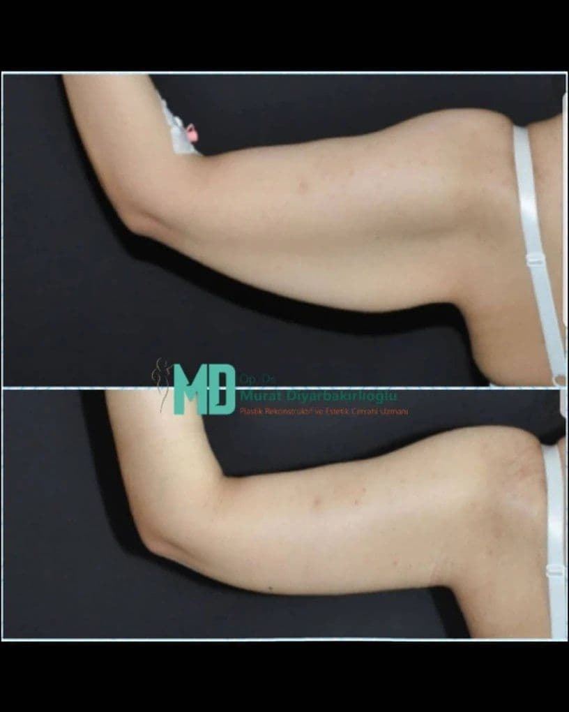 Arm Lift Before After 05 1