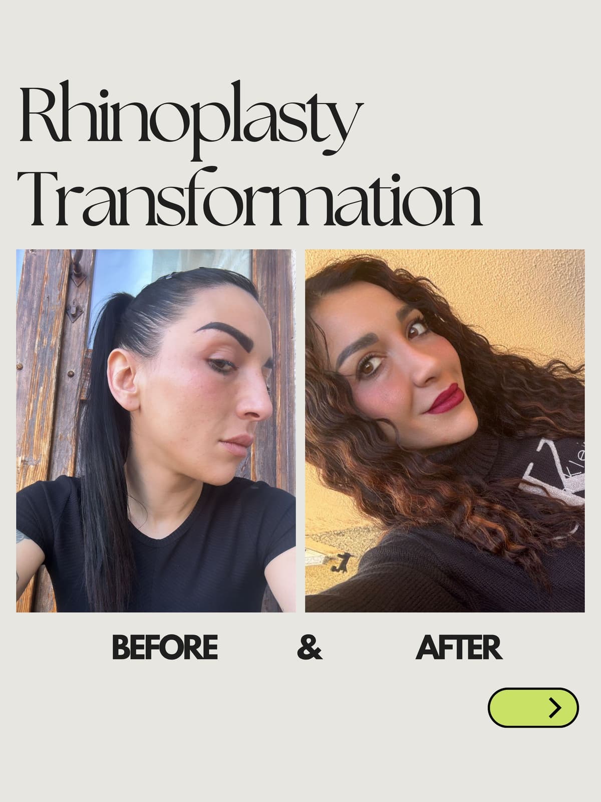 Best Rhinoplasty Clinics in Istanbul: An Honest Comparison (2026)