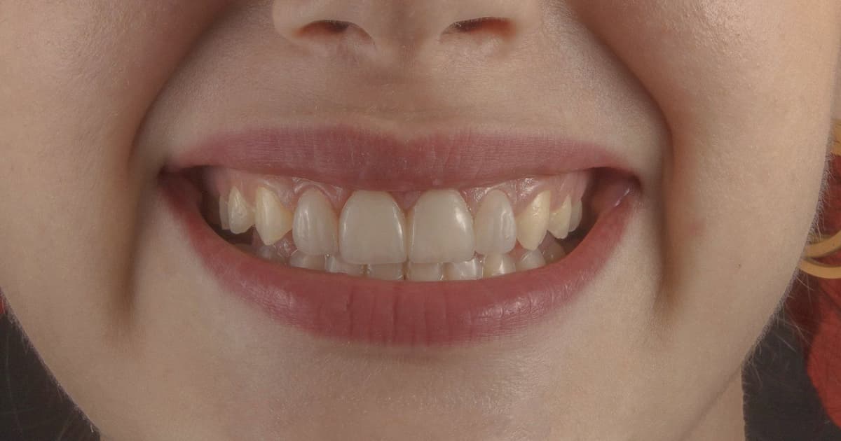 Implantes dentales en Turquía: precio, marcas y cómo elegir (2026)