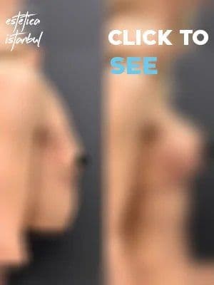 Breast Before After Eng 1