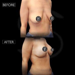 Breast Lift Before After Turkey