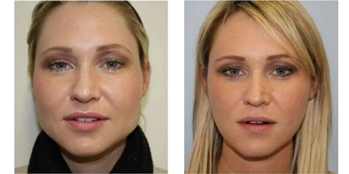 Bichectomy Before After 04 2