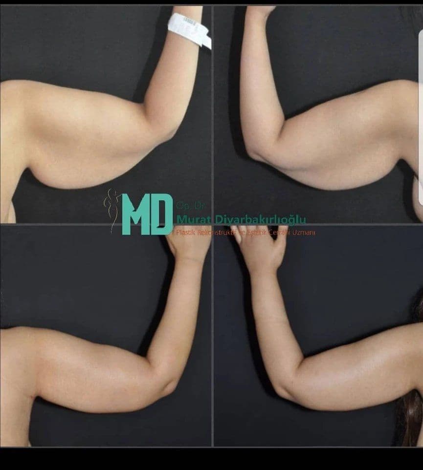 Arm Lift Before After 12 1