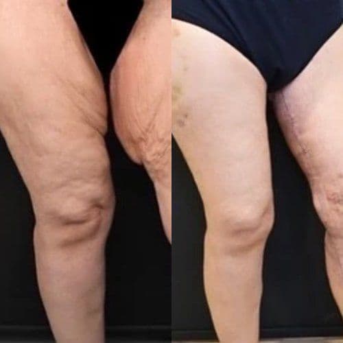 Thigh Lift Before After