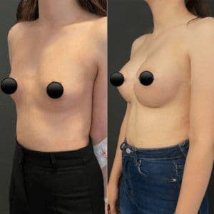 Breast Augmentation Surgery Before After
