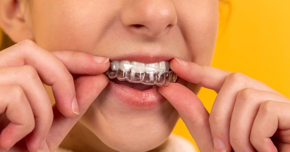 Türkiye'de Hollywood Gülüşü: İstanbul'da Diş Kaplamaları Hakkında Tam Rehber