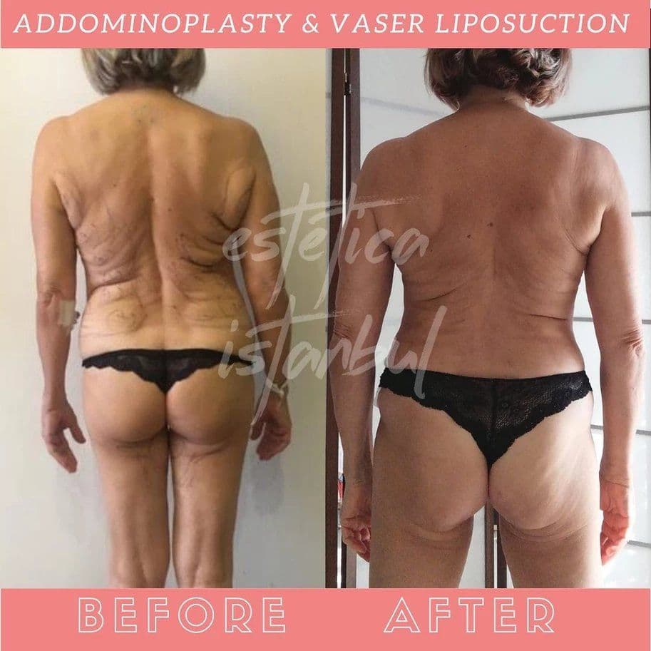 Tummy Tuck Before After 09