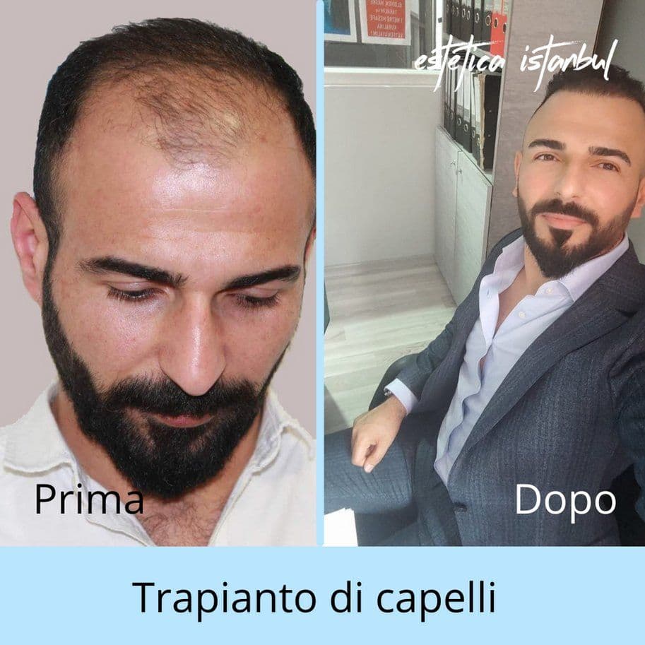 Os transplantes capilares são dolorosos?