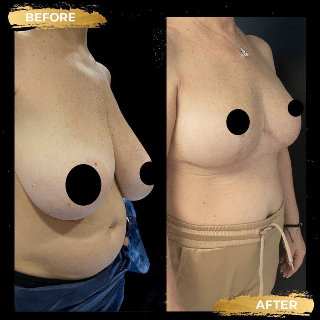 Breast Reduction Surgery Before After Turkey