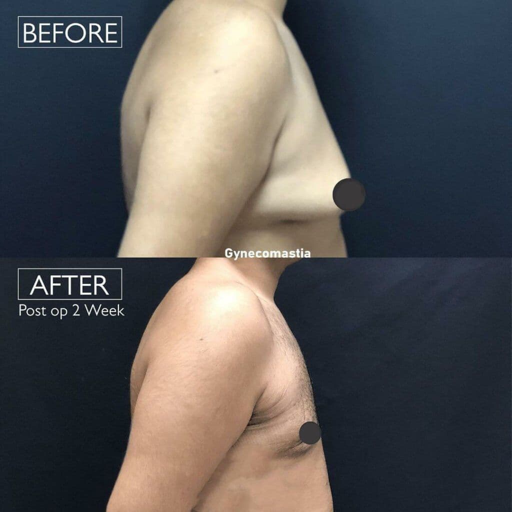 Before And After Gynecomastia Photos In Istanbul