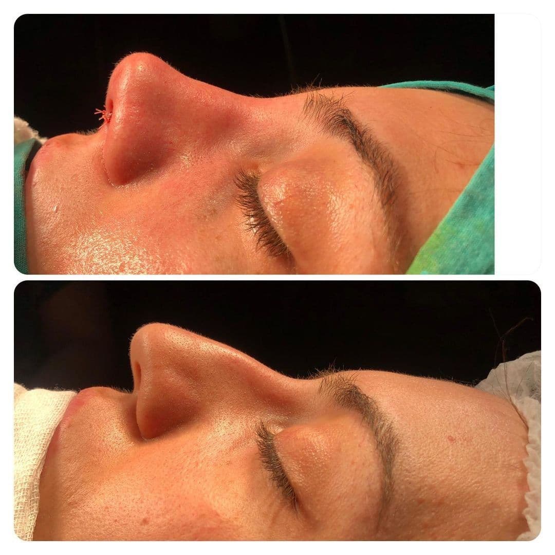 Rhinoplasty Surgery Before After Turkey