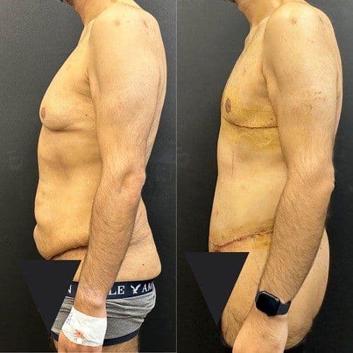Male Bariatric Surgery Before After