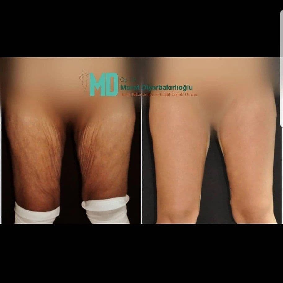 Thigh Lift Before After Photo 04 1