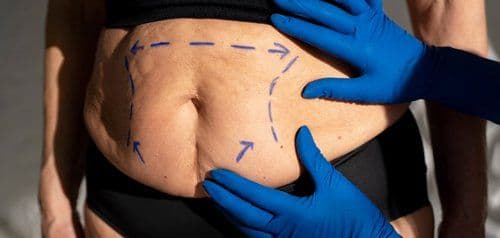 Addominoplastica
