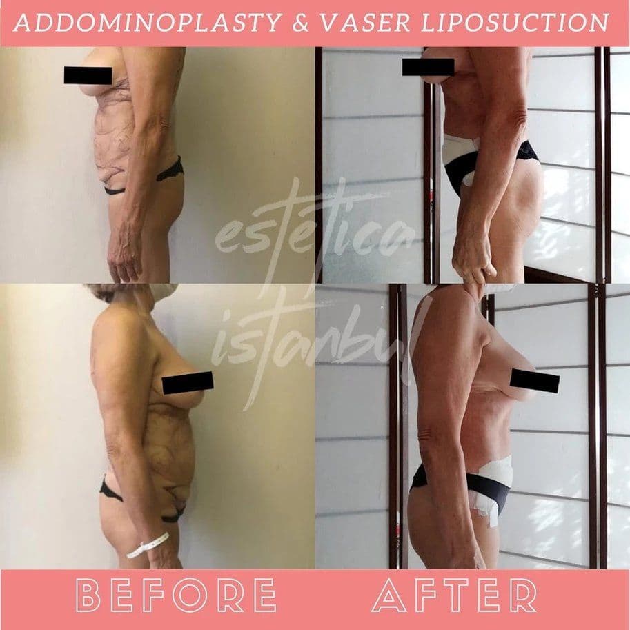 Tummy Tuck Before After 12
