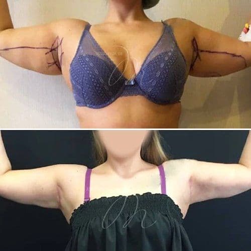 Arm Lift Before After Turkey