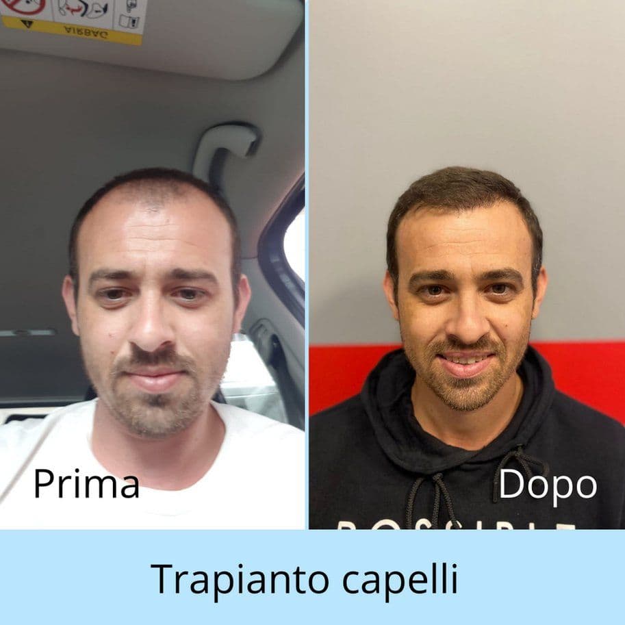 Primeiro corte de cabelo após transplante capilar: o guia definitivo