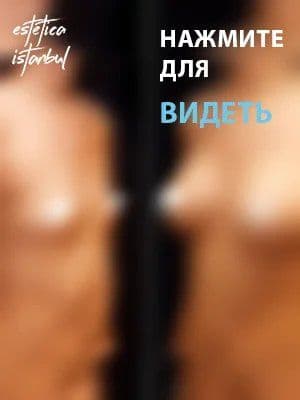 Breast Before After Ru 4 1 1