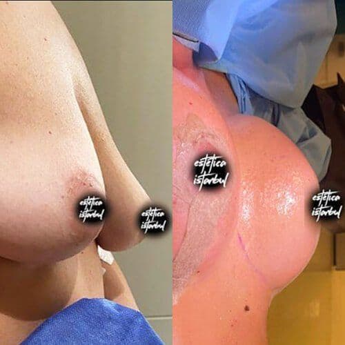 Breast Lift Before After Turkey