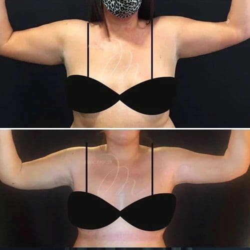 Arm Lift Turkey Before After