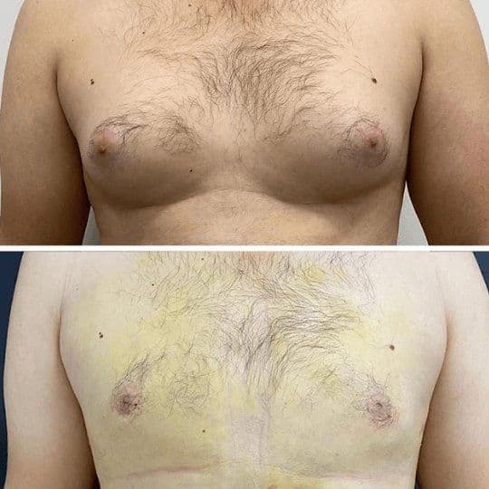 Gynecomastia Before And After Turkey