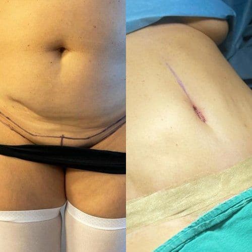 Tummy Tuck Surgery Before After