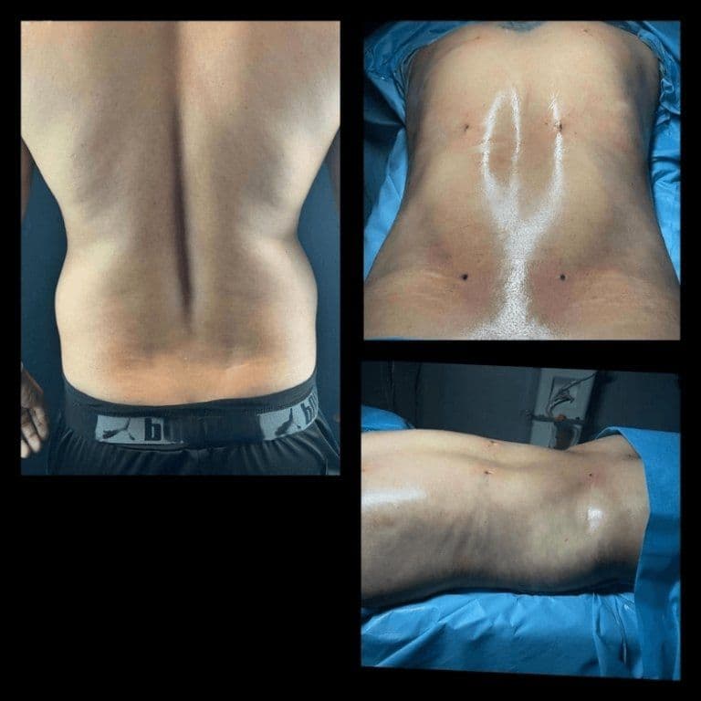 Liposuction Surgery Turkey Before After