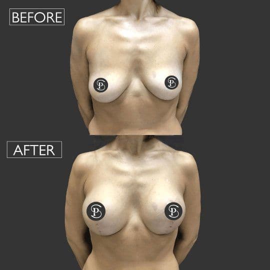 Breast Lift Before And After