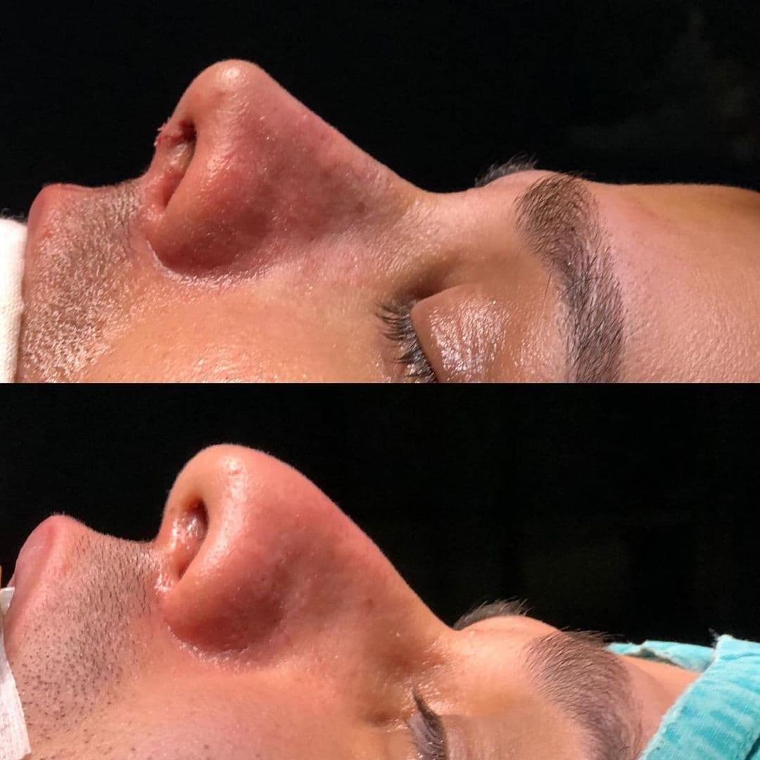 Rhinoplasty Before After Male