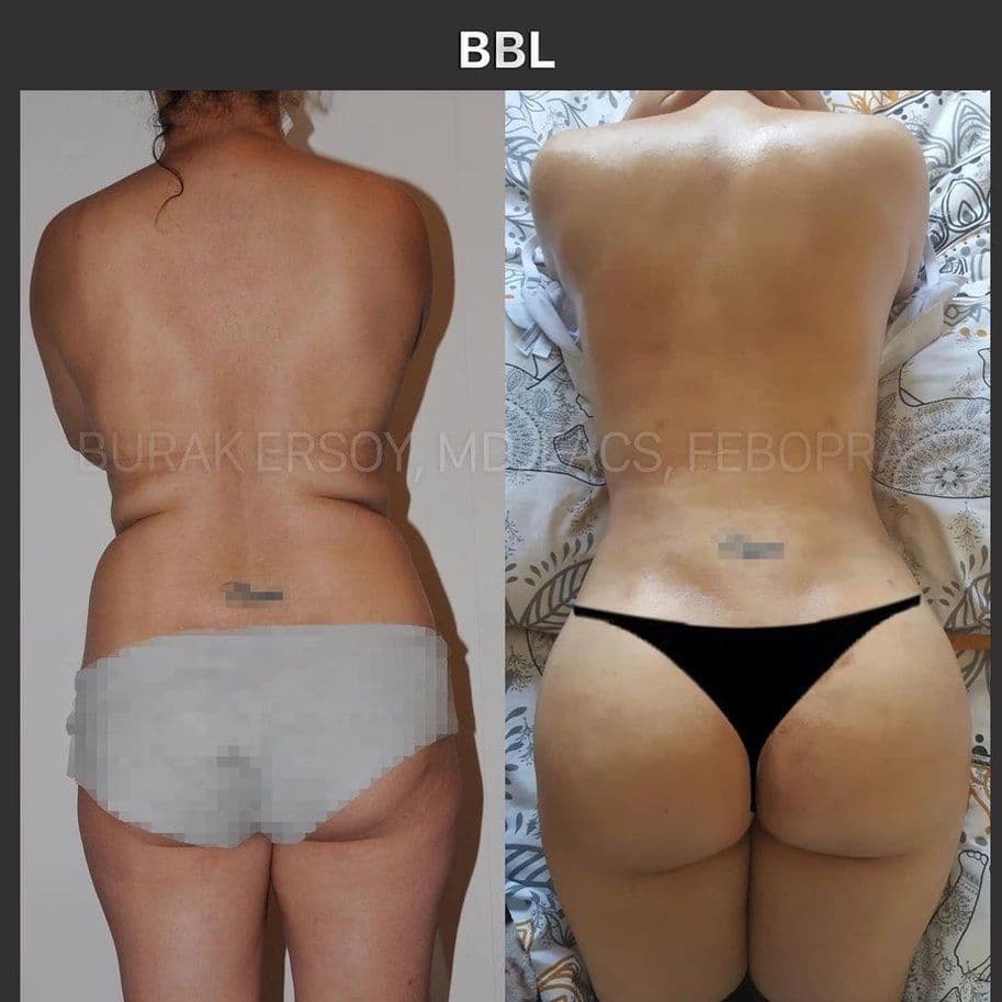 Brazilian Butt Lift Before After 09