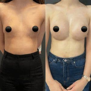 Breast Augmentation Turkey After
