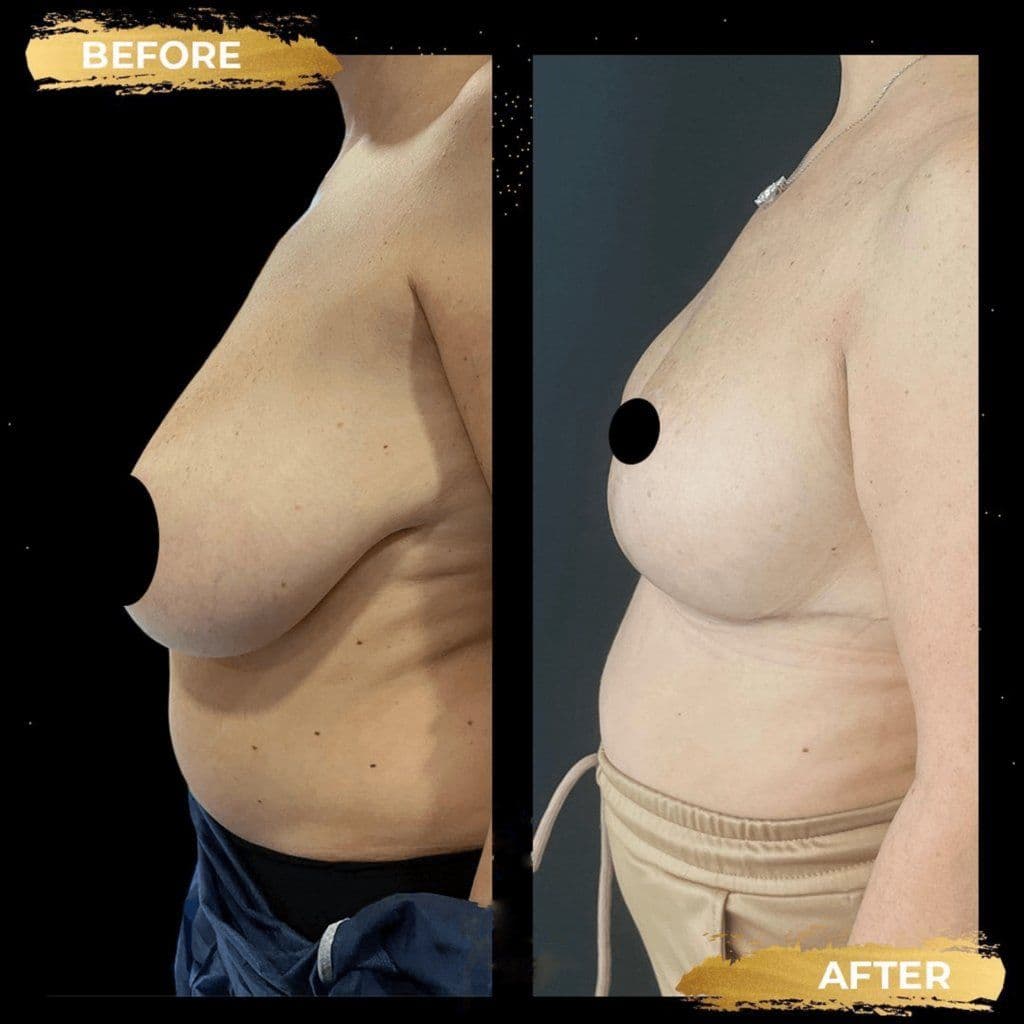 Breast Reduction Surgery Before After