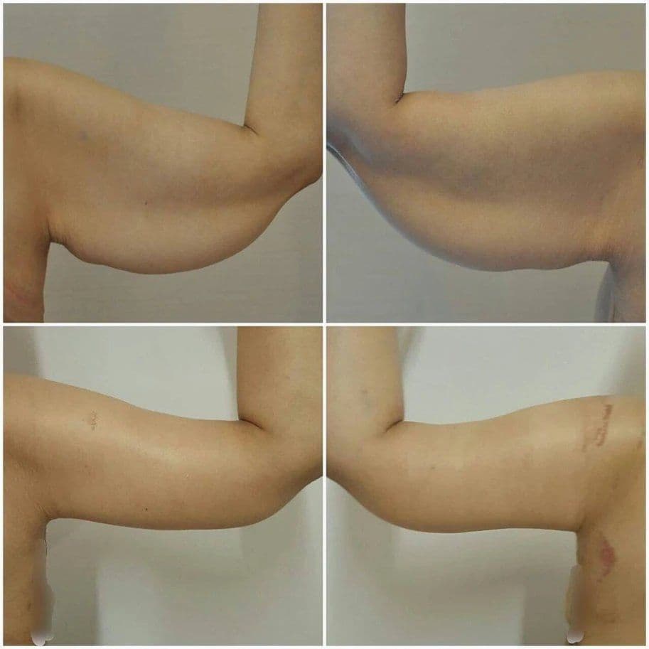 Arm Lift Before After 08