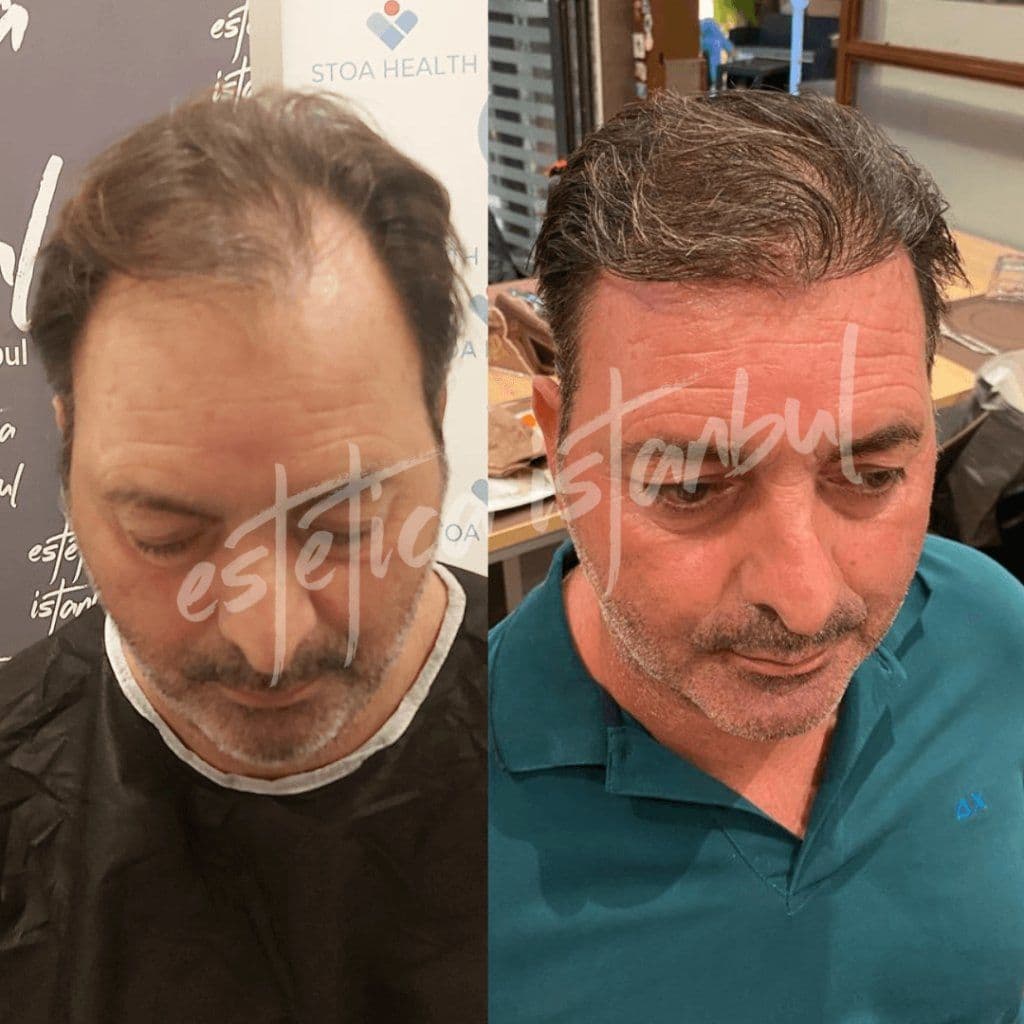 Utiliser un shampooing après une greffe de cheveux