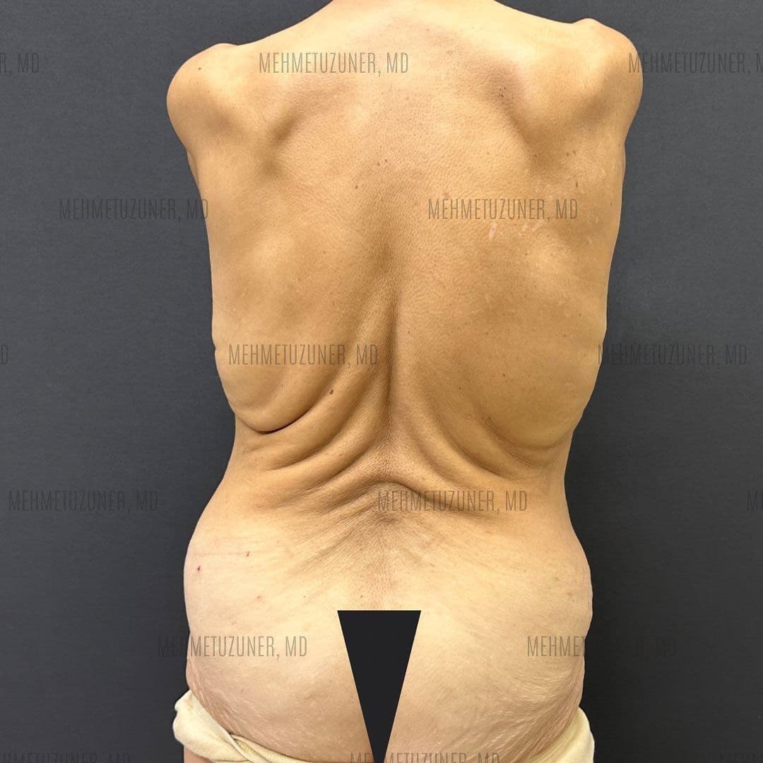 Chirurgia rękawa żołądkowego w Stambule: Kompletny przewodnik pacjenta