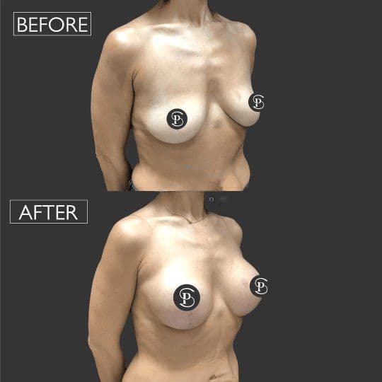 Breast Lift Before After