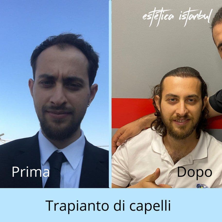 Hair Transplant Before After 03