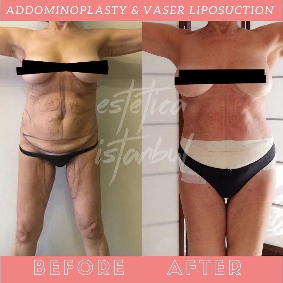 Recupero dall'addominoplastica: la tua guida completa settimana per settimana