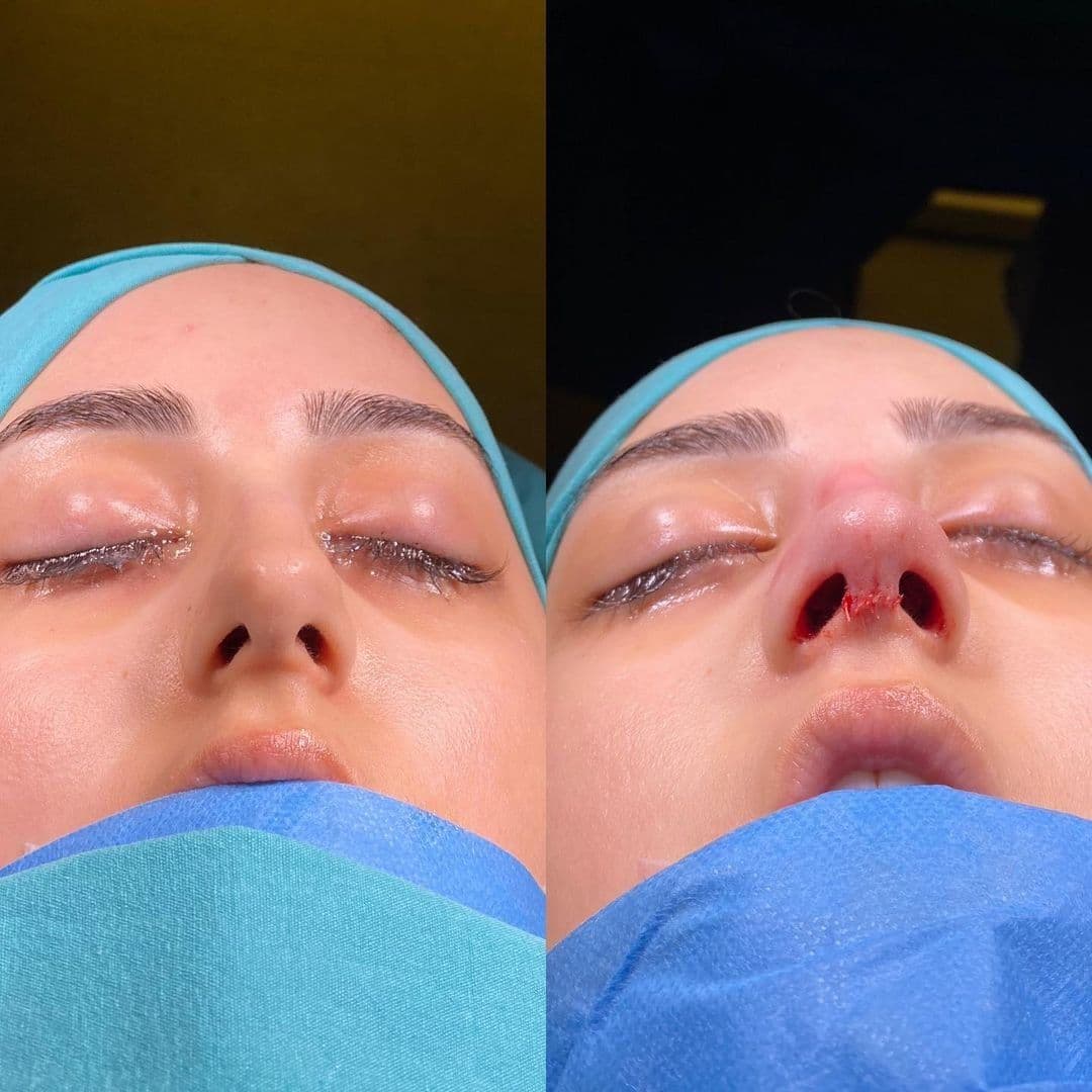 Rhinoplasty Turkey Before After