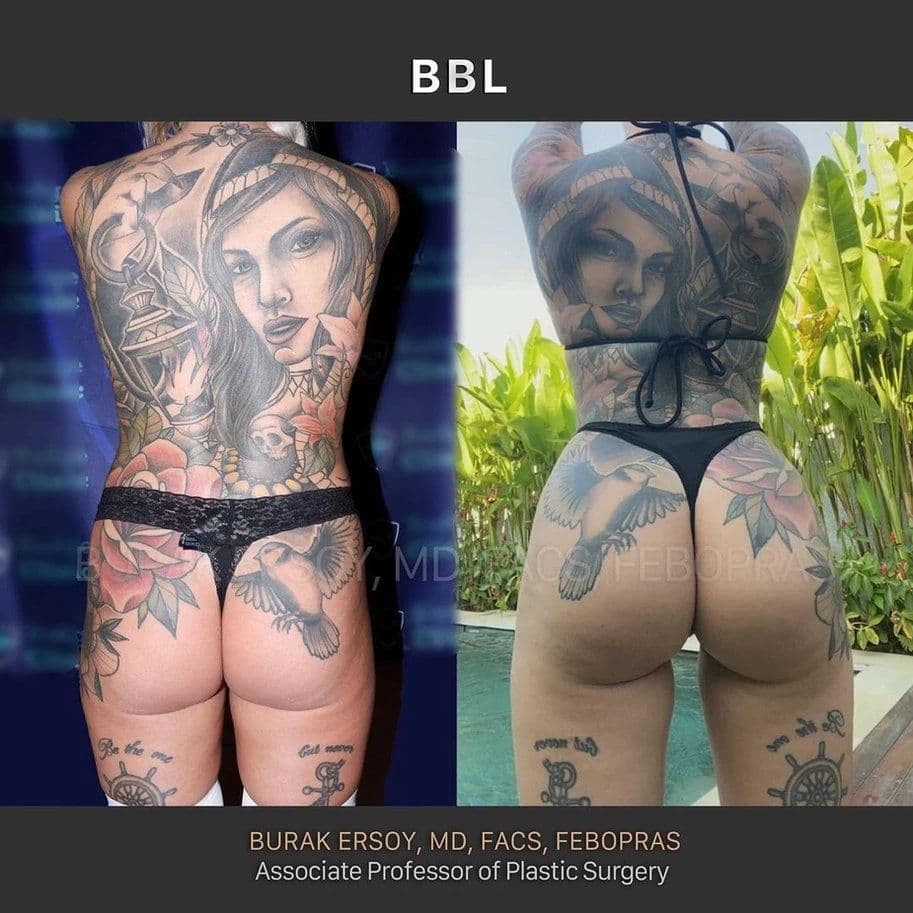 Bezpieczeństwo BBL: Jak najlepsi chirurdzy Stambułu minimalizują ryzyko