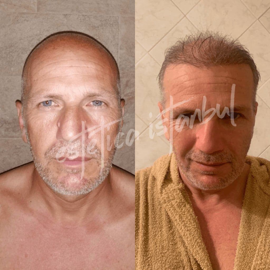 Hair Transplant Turkey Before After