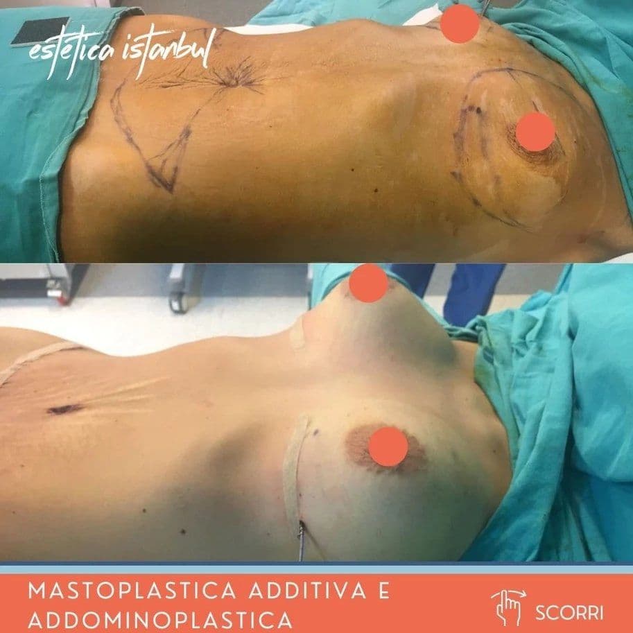 Bauchstraffung Genesung: Ihr vollständiger Wochenführer (2026)