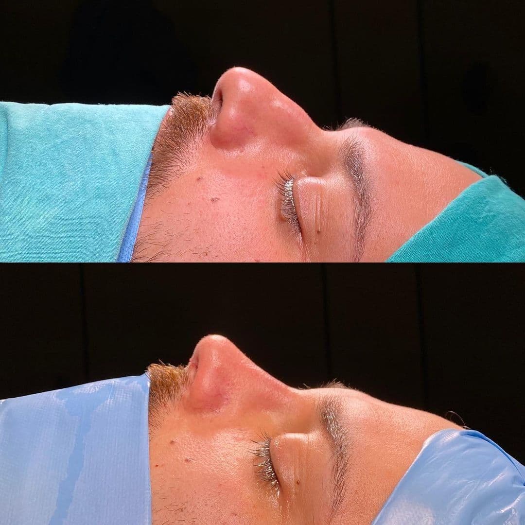 Rhinoplasty For Men Turkey Before After