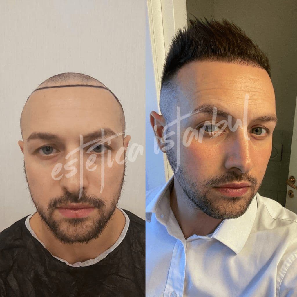 Hair Transplant Surgery Turkey Before After