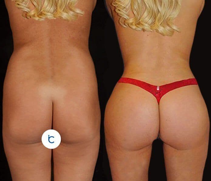 Bbl Before After In Turkey