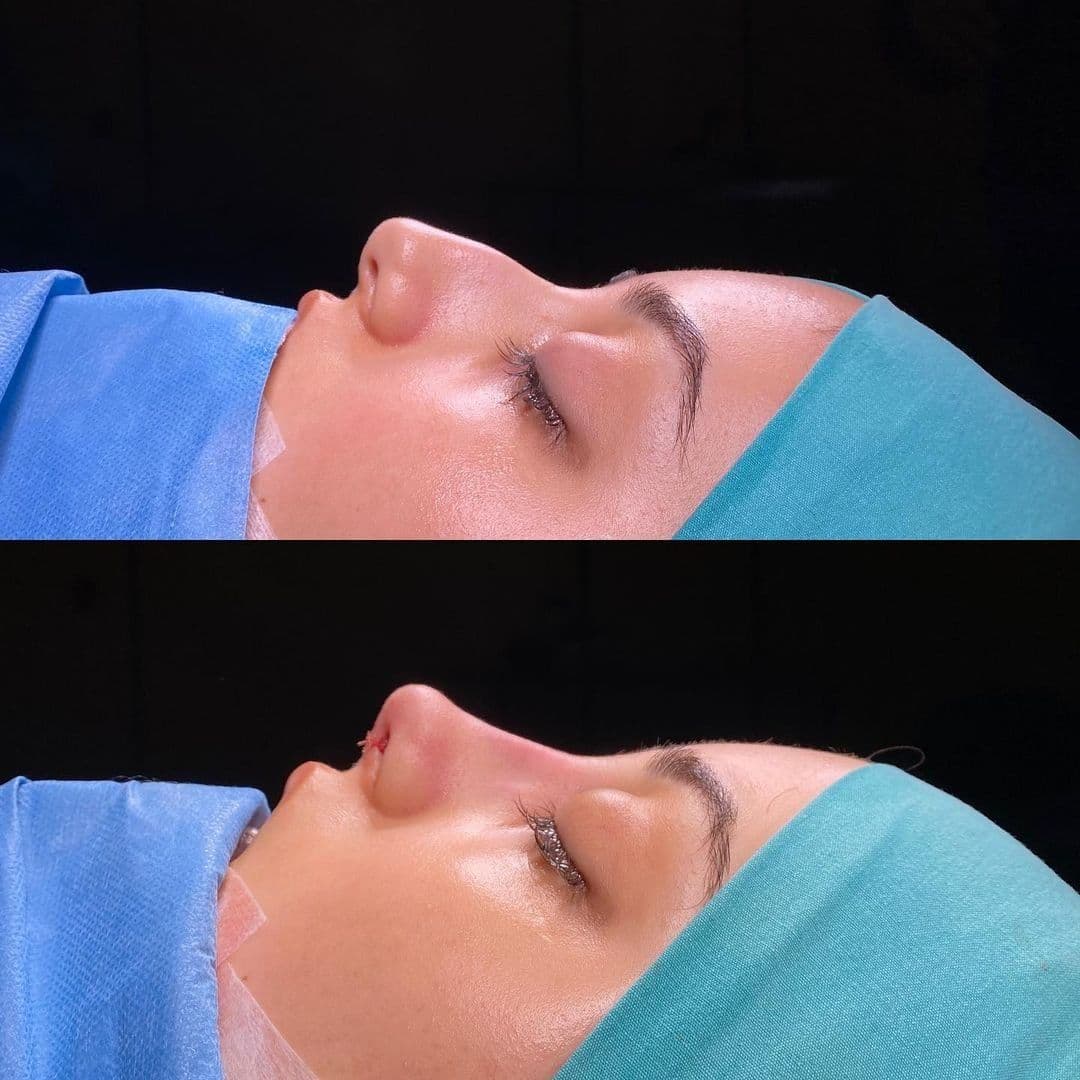 Rhinoplasty Before After